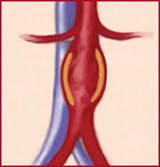 Aneurisma Aórtico Abdominal