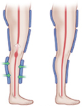 Enhanced External Counterpulsation 