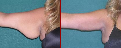 Before/After Arm Lift Surgery Before/After Arm Lift Surgery