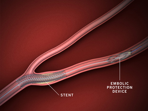 Stent placed in carotid artery along with embolic protection device, as done at Stony Brook.