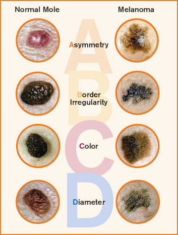 skin-cancer-abcd.jpg