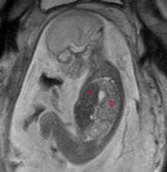 Fetal MRI of 21-week-old fetus with congenital diaphragmatic hernia, showing abnormal liver (*) and bowel (**) in chest. an image is here